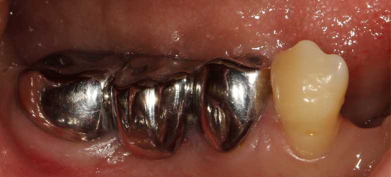 Окисление в рту при использовании зубных коронок — вред для здоровья полости рта и способы его предотвращения