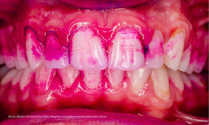Распространенность и выраженность гиперестезии твердых тканей зубов