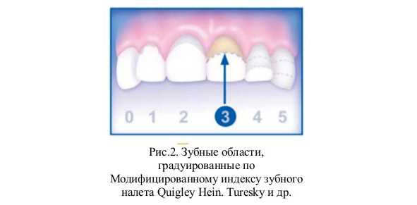 Окрашивание зубного налета проводится при проведении индексов