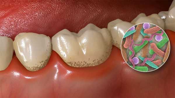Как образуется зубной налет