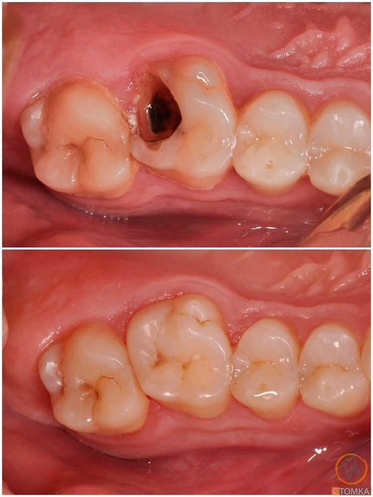 Ортодонтическое лечение и кариес
