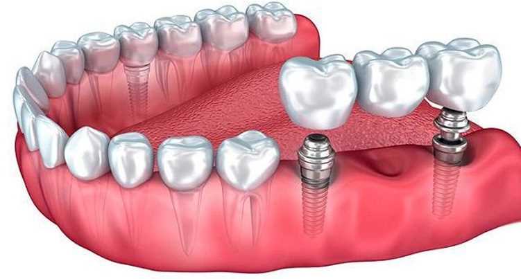 Ортопедия в стоматологии - что это