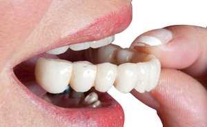 Зубные протезы без возможности снятия