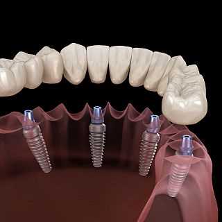 Особенности протезирования зубов в зависимости от объема «потерь»