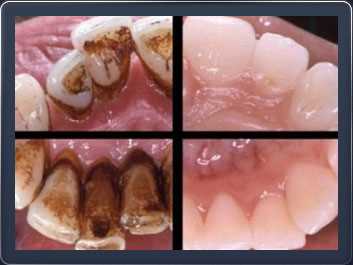 Причины образования зубного камня