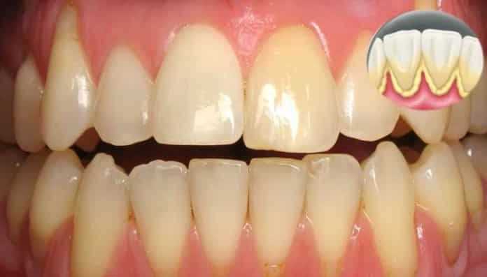 Профилактика зубного камня