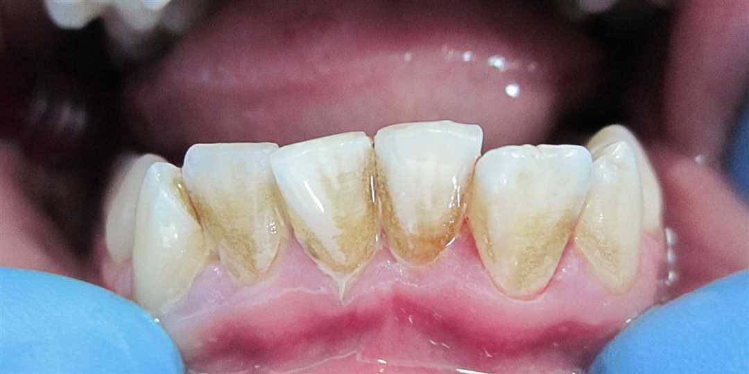 Зубной камень как образуется, уход и профилактика