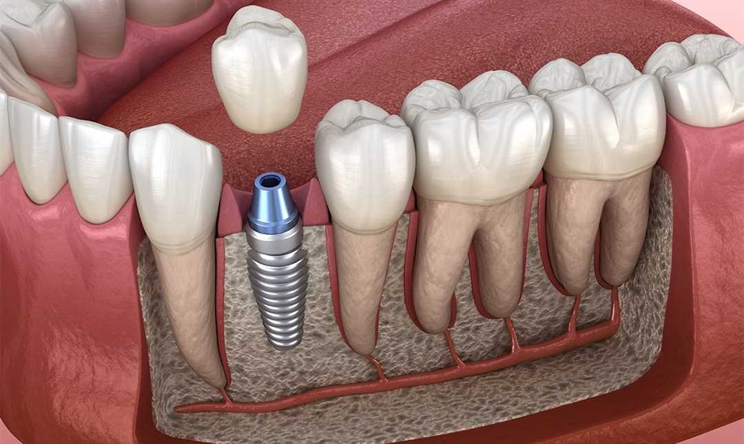 Современный подход к протезированию зубов