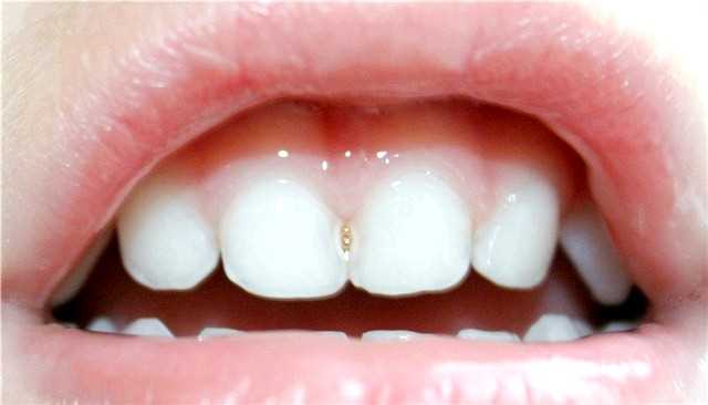 Отсроченное лечение кариеса молочного зуба