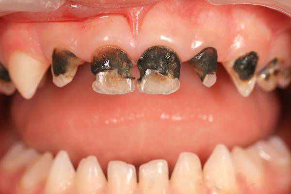 Отсроченное пломбирование при кариесе постоянных зубов у детей с несформированными корнями