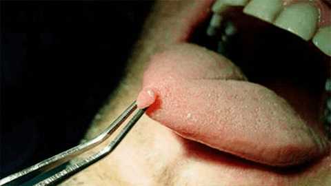 Чем опасны папилломы во рту?