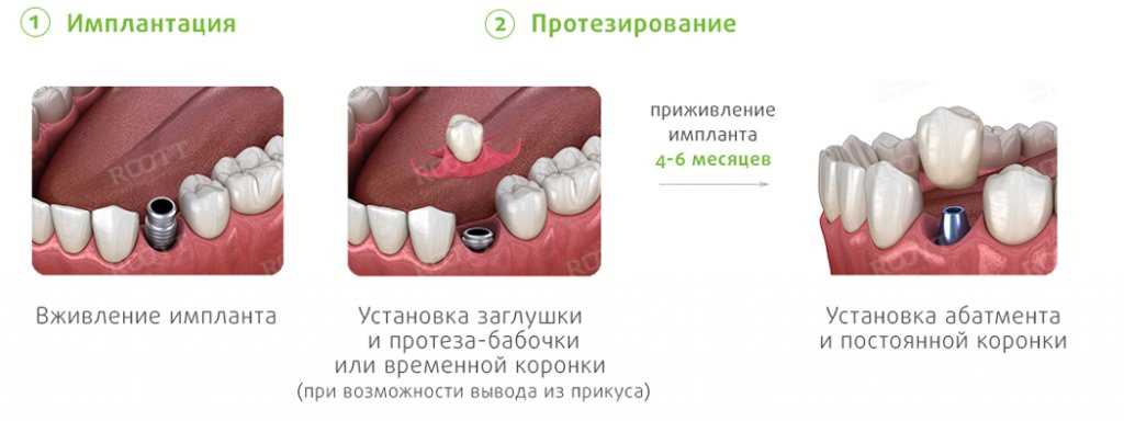 Ортодонтическая подготовка