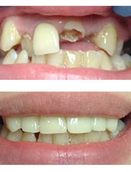 Подготовка зуба к протезированию коронкой