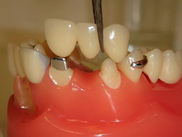 Подготовка к протезированию зубов