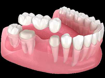Перед протезированием зубов