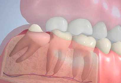 Важность подготовки перед удалением зуба