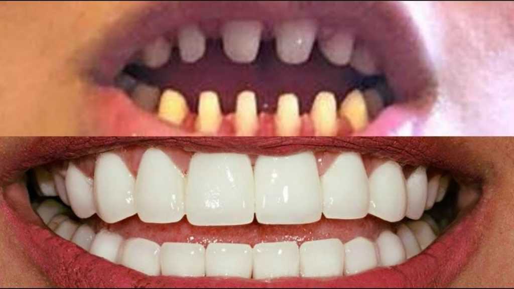 Передние зубные коронки