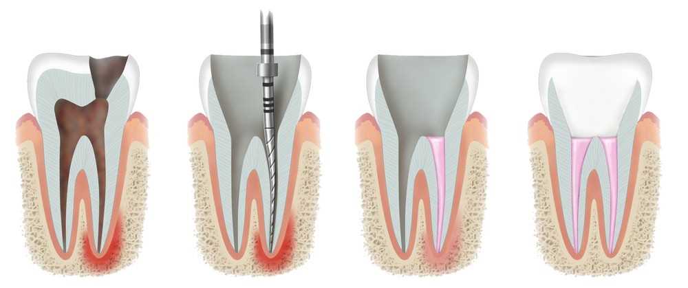 Боль зуба после лечения пульпита и периодонтита
