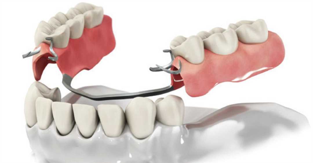 Первое протезирование зубов — все, что вам необходимо знать для успешной реабилитации