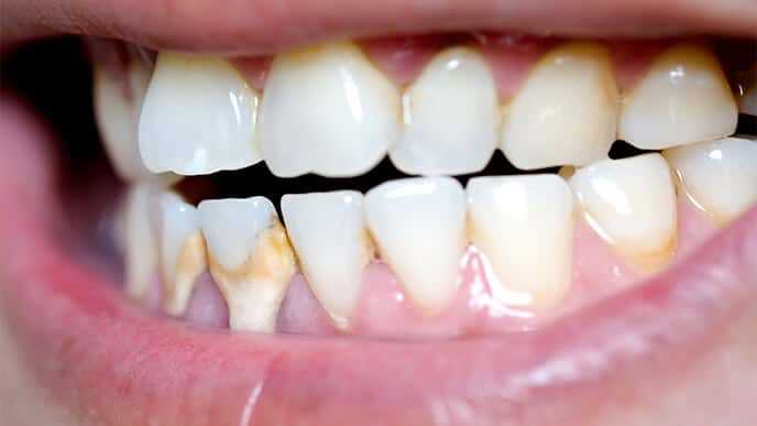 Причины образования поддесневого зубного налета