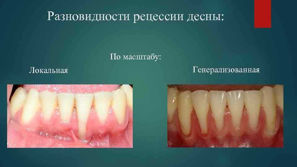 Будут ли десны восстанавливаться после процедуры удаления зубного камня?