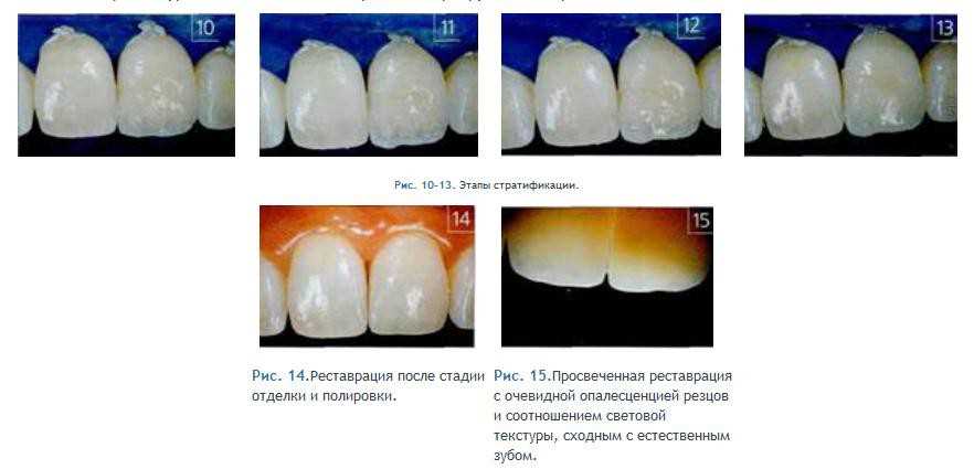 Противопоказания к полировке зубов