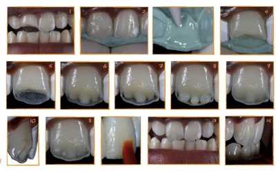 Полировка реставрации зуба
