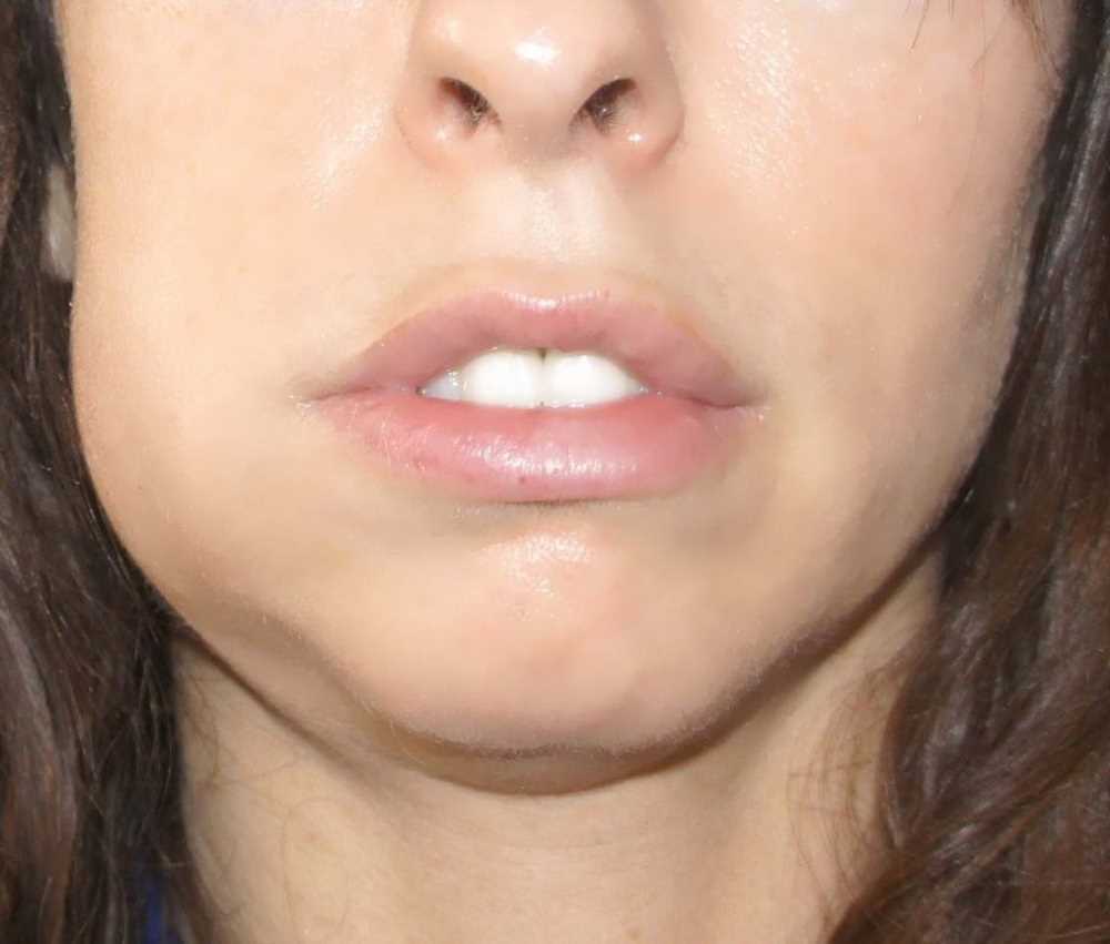 Причины отека щеки после пломбирования зуба