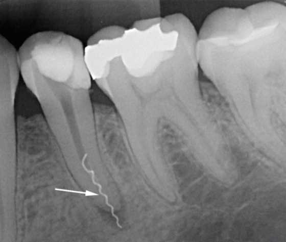 Причины боли в зубе после терапии пульпита