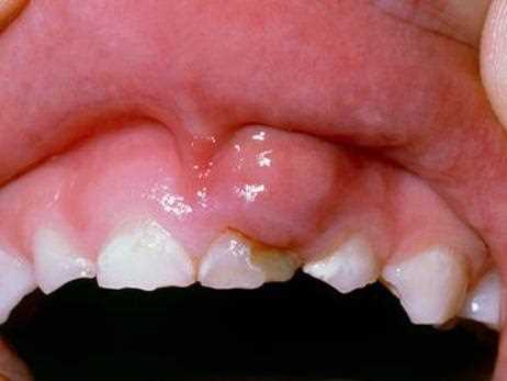 Почему после лечения зуба болит десна