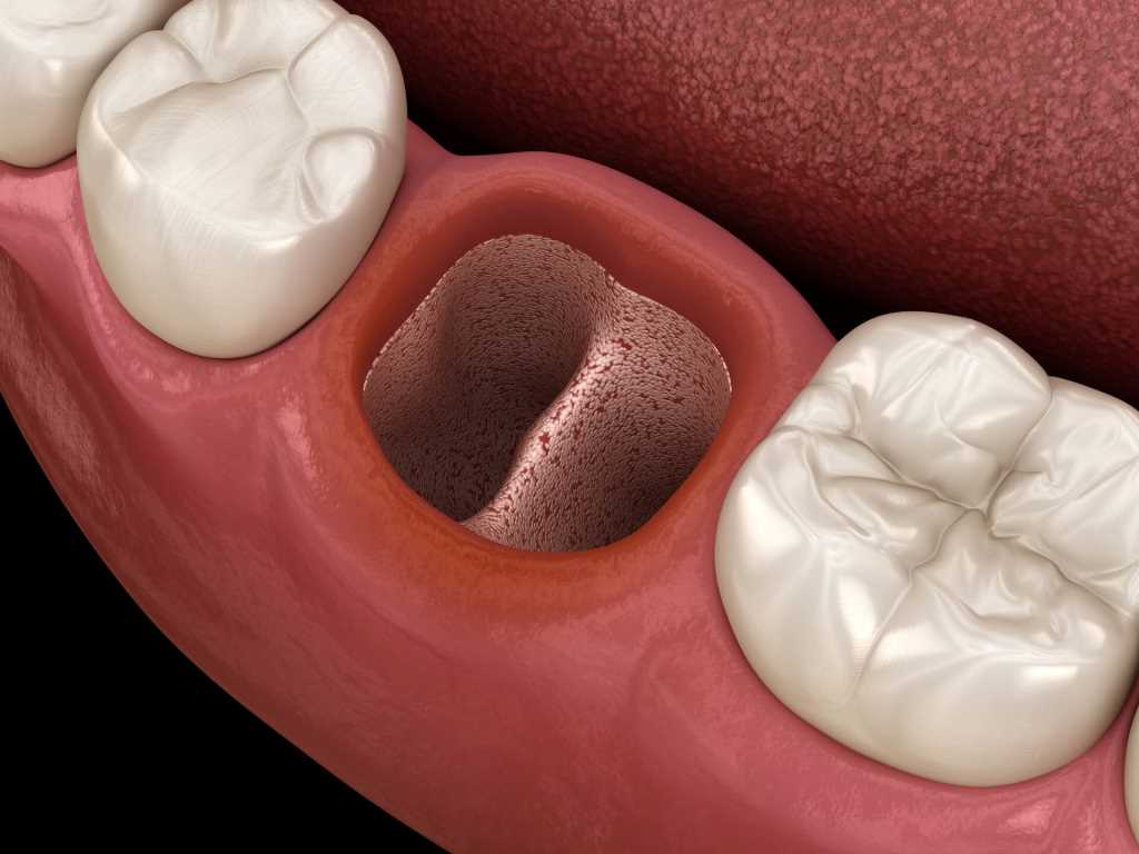 Как сделать так, чтобы после удаления зуба не было осложнений?