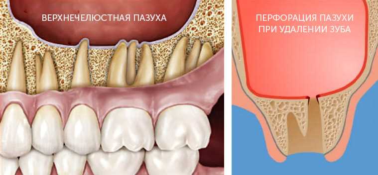 Что кладут в лунку после удаления зуба?