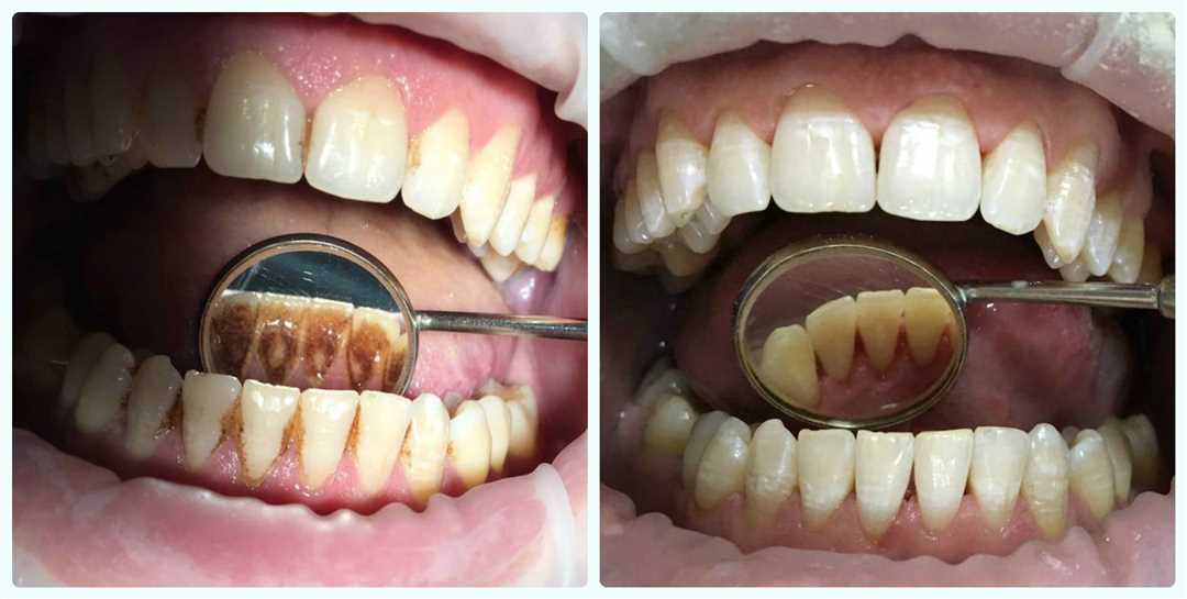 Памятка пациенту после профессиональной чистки зубов