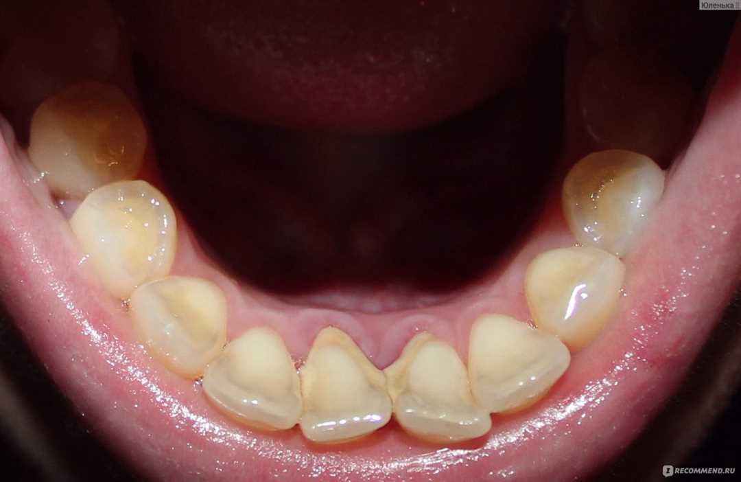Почему шатаются зубы у взрослых?
