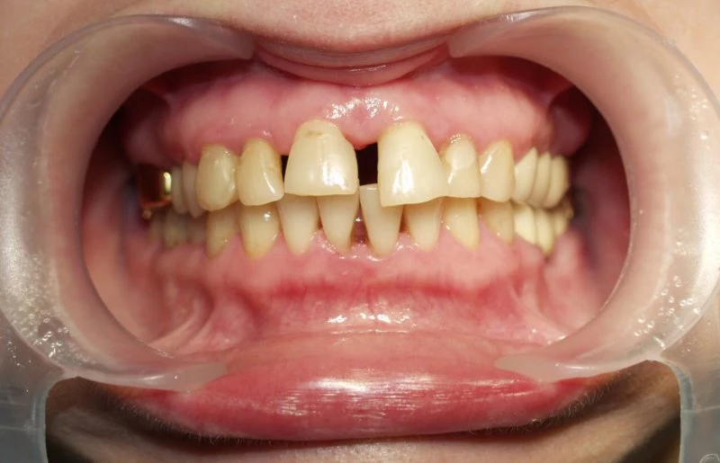 После удаления зубного камня зубы начинают шататься — причины и решения