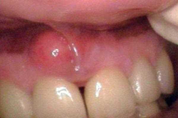 Последствия анестезии зуба