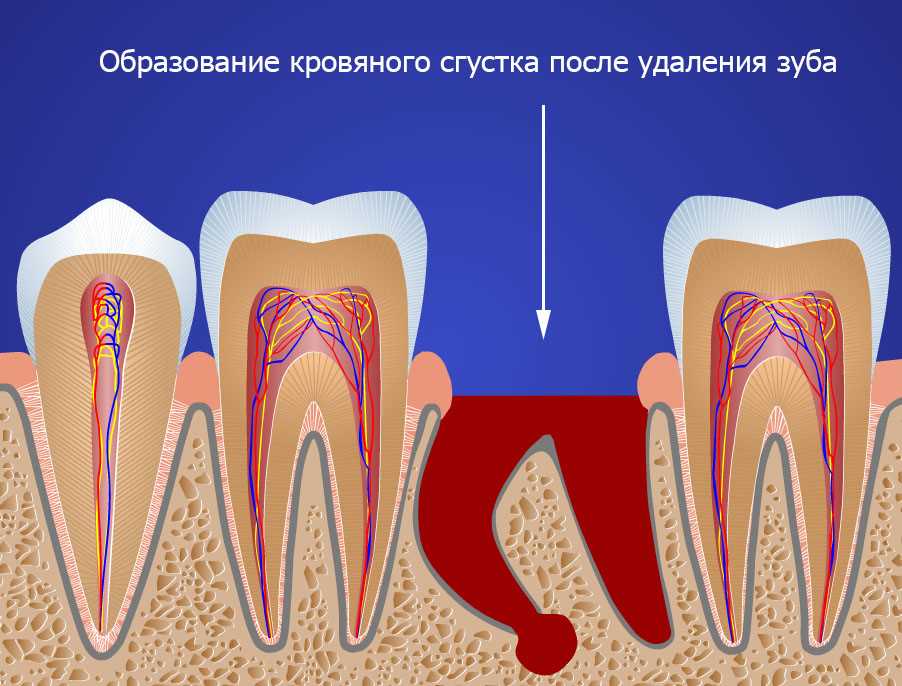 Какие осложнения могут возникать при удалении зуба, и как при этом стоит поступать?