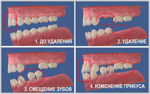 Последствия удаления зуба