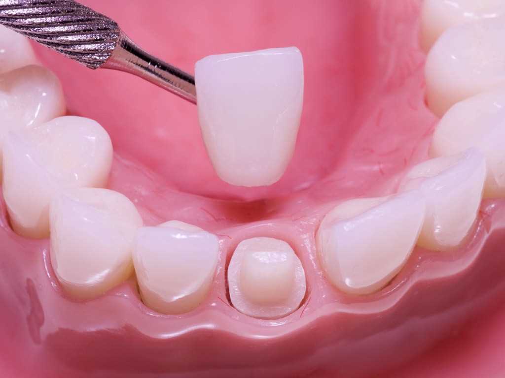 Изготовление протеза в зуботехнической лаборатории - четвертый этап установки коронки
