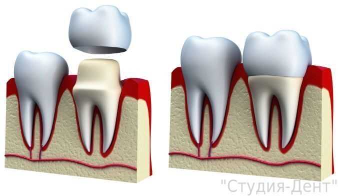Способы протезирования зубными коронками