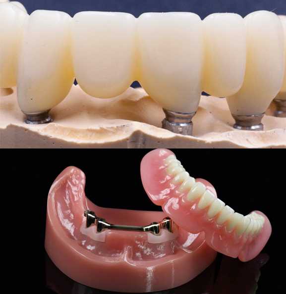 Постоянное протезирование зубов