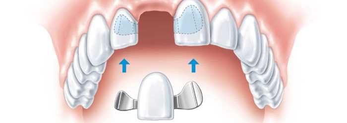 Текст научной работы на тему «Особенности повторного протезирования при полной потере зубов»