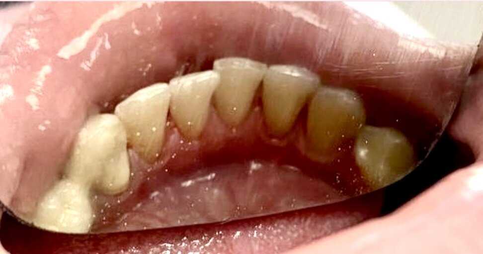 Осложнения зубного камня
