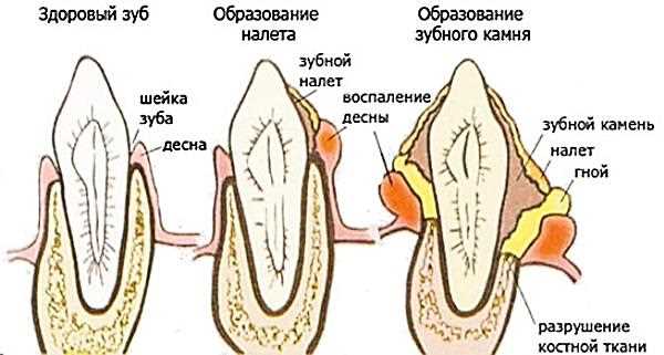 Почему камни на зубах образуются с разной интенсивностью