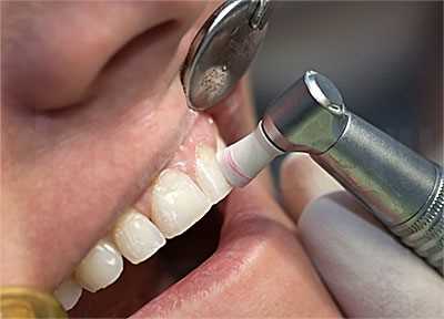 Противопоказания для выполнения электрофореза зубов