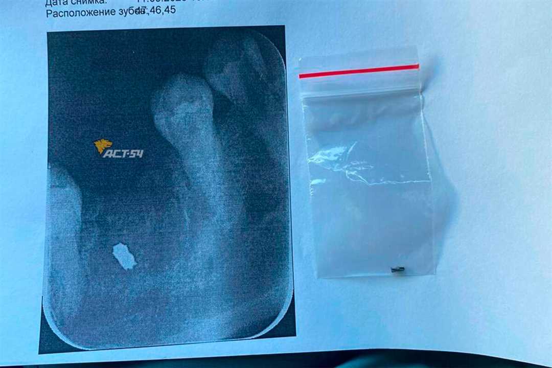 В Петербурге ребенок проглотил наконечник бормашины на приеме у стоматолога