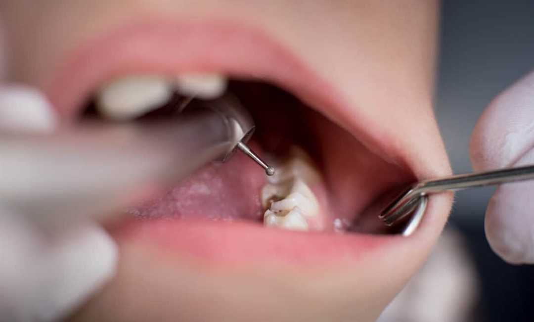 При сверлении зуба бормашиной женщина нечаянно проглотила насадку — экстренная операция спасла ее жизнь