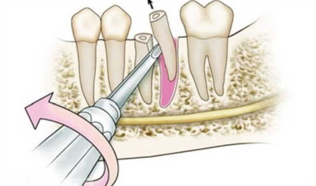 Частые причины удаления зубов