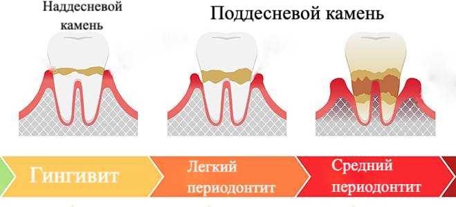 Почему образуются налеты на зубах — раскрытие причин
