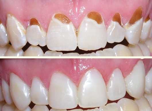 Восстановление зубов при помощи пришеечной реставрации — инновационный метод сохранения естественной эстетики и функции полости рта